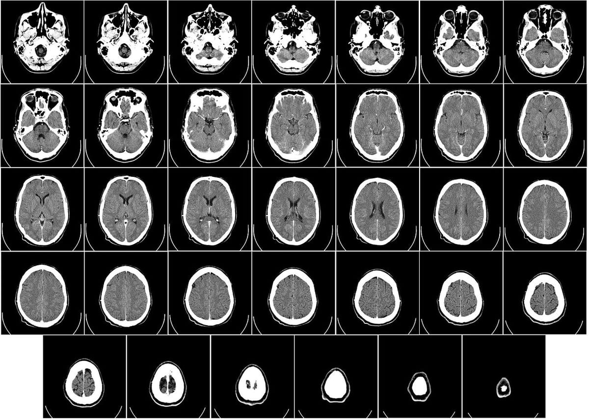 An end in sight for Huntington's disease?